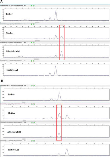 Figure 5 (A) Capillary electrophoresis results of DXS1194. The red-bordered box represents the STR alleles linked to the mutant allele of the AR gene. (B) Capillary electrophoresis results of DXS8111. The red-bordered box represents the STR alleles linked to the mutant allele of the AR gene.