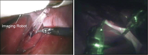 Figure 6. Cooperative laparoscopic da Vinci® procedure as viewed from da Vinci® laparoscope (left) and imaging robot (right). [Color version available online.]