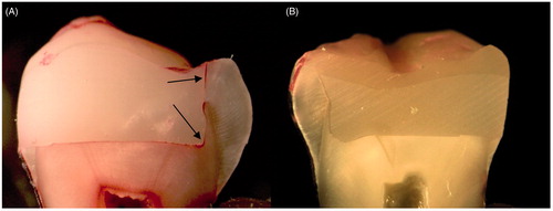 Figure 2. Picture of sectioned specimen showing (A) microleakage at restoration margin and (B) no microleakage.