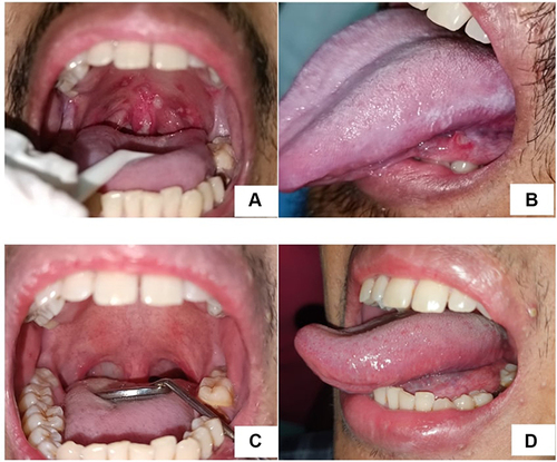 Figure 4 Multiple ulcers on soft palate, oropharynx, uvula (A), single ulcer on ventrolateral of the tongue and white corrugated, adherent plaques on left lateral of the tongue (B) two months after first visit, the lesions improved (C and D).