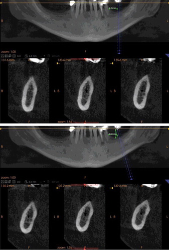 Figure 3. Second molar implant site in which the visibility score of the mandibular canal (arrow) was less on orthoradial (a) than oblique slices (b).