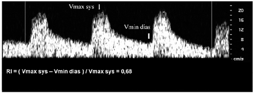 Figure 1. Intrarenal Doppler Flow Spectrum: Calculation of Resistive Index (RI).