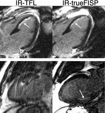 Figure 2. Top Panel: A septal infarct (white arrow) is identified by IR-TFL and IR-trueFISP. Bottom Panel: Breathing artifact is readily apparent in the IR-TFL image. Acquisition using IR-trueFISP enabled a clearer image to be obtained. A subendocardial inferior infarct can be seen (white arrow).