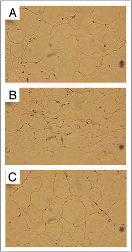 Figure 1 Histology of fresh or cryopreserved fat grafts (H&e staining, original magnification ×200, Bar = 100 µm). (A-Top) Group 1 (Fresh control) showing essentially normal histology of adipose tissue; (B-Middle) Group 2 (Cryopreservation without CPA) showing very prominent shrinkage of adipose tissues with evidence of broken adipocytes compared with Group 1; (C-Bottom) Group 3 (Cryopreservation with 0.5 M DMSO and 0.2 M trehalose) showing near normal histology of adipose tissue compared with Group 1. (reprinted with permission from Pu LLQ, et al. Long-term preservation of adipose aspirates after conventional liposuction. Aesthetic Surg J 2004; 24:6).