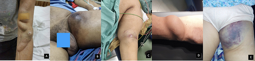 Figure 2 Clinical pictures of the cannulation complications from vascular access in ESKD patients: (A) Giant draining vein shown as a long pulsatile mass in the draining vein; (B) Ruptured pseudoaneurysm covered with a blood crust; (C) Impending rupture pseudoaneurysm with tense and glistening skin; (D) Pseudoaneurysm shown as a pulsatile mass without pain or bleeding; (E) Hematoma with bruise.