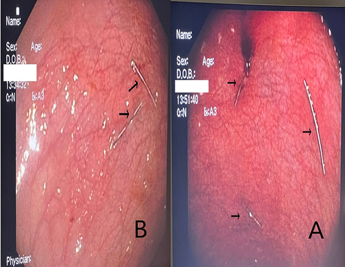 Figure 3 (A) Endoscopic view of the three paired anchor shots (tips of arrows) disposed in a triangular fashion, (B) Endoscopic view of one pair of the anchor shots (tips of arrows).