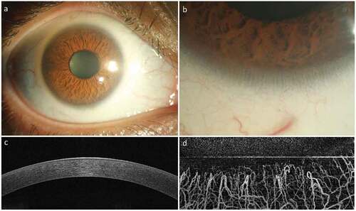 Figure 1. Normal Appearance of the Cornea and Limbus. The healthy cornea is optically transparent (a) and surrounded by the annular limbus which separates it from the opaque sclera. The limbus contains the palisades of Vogt (b) which are finger-like projections of the stroma. The optical coherence tomography (OCT) image of the normal cornea shows a smooth uniform stratified epithelium (c) with underlying compact stroma. The OCT angiography image of the normal limbus shows linear anastomosing hair-pin loops of the limbal capillaries (d) with adjacent avascular corneal stroma.