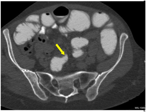 Figure 1c: Axial CT showing SBO with abrupt transition point (yellow arrow) with no associated mass in keeping with an adhesive band, confirmed at surgery