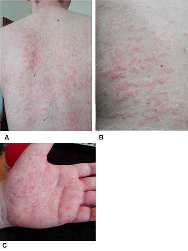 Figure 1 The trunk (A and B) and palm (C) of the hand covered in urticarial rash observed in a Schnitzler syndrome patient during treatment with tocilizumab.