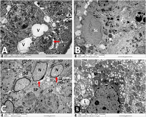 Figure 5. Electron micrographs of testicular tissue from the MTX group. (A) Part of Sertoli cell (Sc) with extensive cytoplasmic loss and vacuolation (V). Note also: deformed primary spermatocyte (PS) displaying perinuclear space (arrow). (B) Sertoli cell (Sc) showing a large number of primary and secondary lysosomes (Ly). (C) Early stage spermatid (Sd) appears with marked irregularities of the nucleus (N) and acrosomal cap (arrow). SP: primary spermatocyte. (D) Deleterious changes in Leydig cell (Lc) are discernible. The nucleus (N) shows contended peripheral chromatin and distended envelope. In the cytoplasm, observe the presence of many lipid vacuoles (L), sparse smooth endoplasmic reticula, and disintegrated mitochondria (M) with broken cristae. Scale bar: 5 µm (A–C), 2 µm (D).