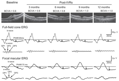 Figure 1 Findings in a representative case of age-related macular degeneration associated with an occult choroidal neovascularization. The eye was treated with three-monthly intravitreal injections of ranibizumab. The serous retinal detachment promptly disappeared after three injections. There was no change in waveforms and amplitudes of the full-field cone electroretinograms after three intravitreal injections of ranibizumab. The amplitudes of the focal macular electroretinograms are slightly larger at 6 months and thereafter.