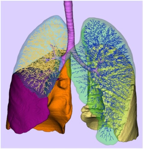 Figure 4 Individualized, 3D deterministic model of the conducting part of the human tracheo-bronchial tree.Notes: For clarity, the branching structure is only shown in the right and left upper lobes. A complete lung structure model will allow for accurate determination of the pulse arrival time at each individual acinus.