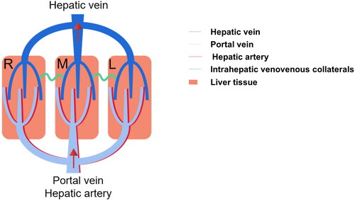 Figure 6. Schematic illustration of intrahepatic venovenous collaterals. There exist several intrahepatic venovenous collaterals between the adjacent hepatic venous drainage areas. This assay indicated the two characteristics of these collateral pathways: 1. Two way opening; 2. Timely opening; 3. Pressure-dependent.