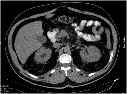Figure 1b. Multi-slice CT scan of abdomen: axial image showing only discrete blurring of the margins of the gland and mild changes in the fat tissue.