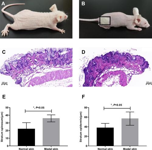 Figure 1 Histological evaluation of the skin (n = 5 mice for each group). (A and B), representative images of normal untreated control mouse (A) and the treated mouse with injection of S. aureus (B). (C and D), representative images of the hematoxylin-eosin staining performed to observe the morphological structure of skin in the control group (C) and treated group (model) (D). (E and F) were thicknesses quantifications of stratum spinosum and stratum epidermis from (C) and (D) (n=5). P-value from t-test. *P <0.05. Error bars indicate mean ± SD.