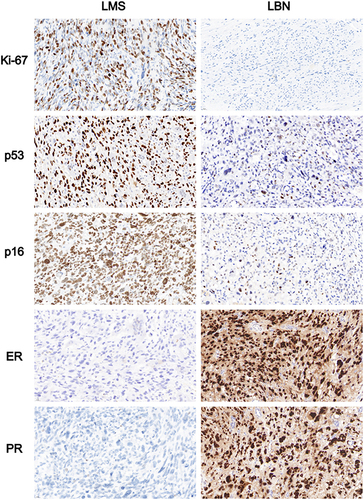 Figure 5 Photomicrographs (40X) illustrating immunohistochemical staining for the five biomarkers Ki-67, p53, p16, estrogen receptor (ER), and progesterone receptor (PR) in leiomyosarcoma (LMS) and leiomyoma with bizarre nuclei (LBN). In contrast to LBN, LMS shows the overexpression of Ki-67, altered p53, p16 expressions, and the loss of ER and PR expression.