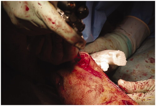 Figure 8. After completion of the osteotomy, we perforated the closed medullary canal visible in the osteotomy cross-section with reference to the bone model and created the intramedullary nail route.