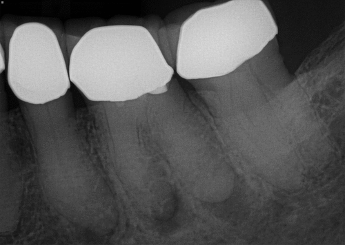 Figure 30. Case 2 pre-operative radiograph showing severe calcification and apical lesion (PARL).