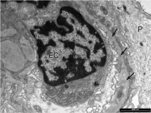 Figure 2 Glomerular capillary loop with granular trace deposits (arrows) in the subendothelium of the capillary basement membrane in a case with Class I lupus nephritis.