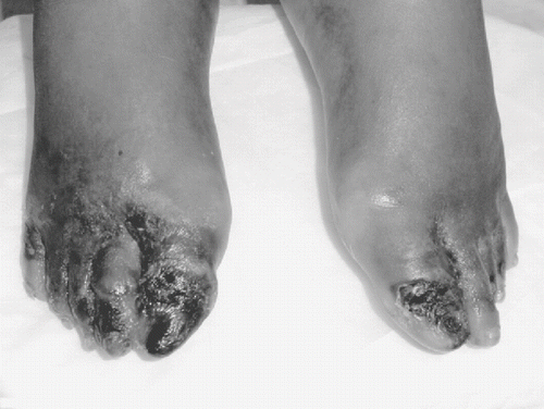 Figure 2. Distribution of lesions on the patient's feet.