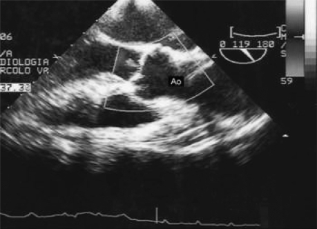 Figure 1 Echocardiogram: no intimal flap is present.