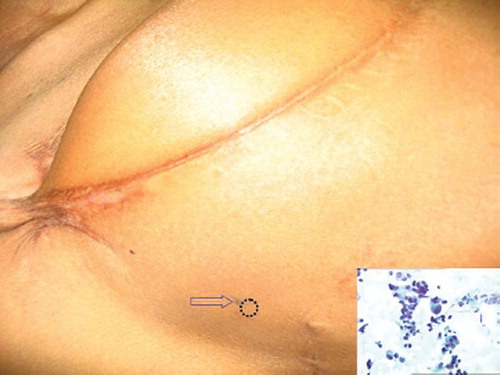 Figure 1. The lateral aspect of the right chest wall of the patient. Note the tattoo mark (arrow) and the area of the recurrent nodule (dotted circle). (Inset) Smear shows loosely cohesive and singly scattered pleomorphic ductal cells with high Nuclear:Cytoplasmic ratio, hyperchromatic nuceli and prominent nucleolisation, seen in a few; against an amorphous and a necrotic background. Papanicolaou stain × 200