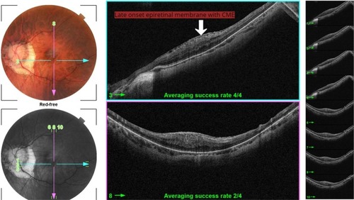 Figure 5 Late ERM >6 months with CME.