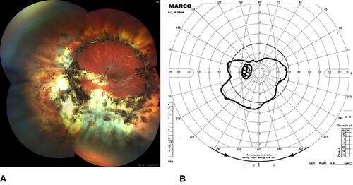Figure 3 (A) Final appearance of the son’s left eye after repair of recurrent RRD/PVR. Postoperative visual acuity is 20/125. Initial RRD was from multiple small defects with lattice. (B) Visual field of the left eye postoperatively.