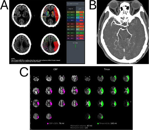 Figure 1 (A) Baseline axial CT performed 360 min after the symptom onset showing a faint hypodensity in the left frontotemporoparietal lobe with a RAPID-ASPECTS of score 1. (B) CTA showed a complete occlusion of the left M1. (C) The RAPID-CTP analysis demonstrated a complete infarct volume of 76 milliliters (mL), entailing a small infarcted core within a large volume of penumbra in the right internal carotid artery vascular territory. The configured Tmax > 6-second volume representing the combination of the infarcted core volume and hypoperfused brain was 143 mL in the left cerebral hemisphere, deriving a mismatch ratio of 1.9.
