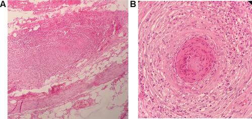 Figure 3 (A) Leukocytoclastic vasculitis in a medium-sized vessel in lymph node (H&E stain, ×100). (B) Leukocytoclastic vasculitis in small vessel in lymph node (H&E stain, ×400).