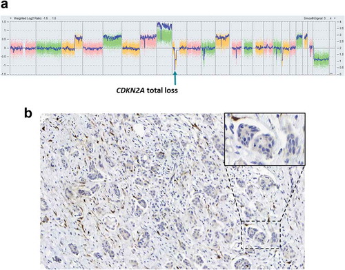 Figure 4. (A) Genomic profile generated by SNP array showing the total loss of CDKN2A. (B) Representative P16INK4a immunohistochemistry image showing the loss of its expression in cancer cells. Inset corresponds to a zoomed portion of the image.