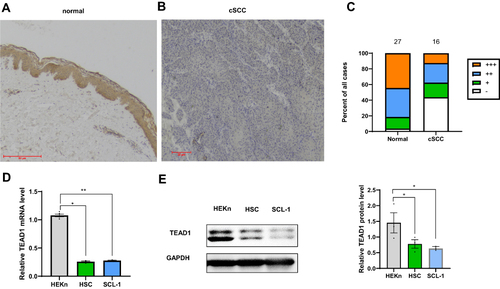 Figure 1 Analysis of TEAD1 expression in different tissues and cells. (A) Normal skin (n=27). Bar length =50μm. (B) cSCC (n =16). Bar length =20μm. (C) Semiquantitative analysis of TEAD1 staining. (D) qPCR analysis of TEAD1 RNA expression in HEKn and two cSCC cell lines: HSC-1 and SCL-1 (E) Western blot analysis of TEAD1 protein expression in HEKn and two cSCC cell lines: HSC-1 and SCL-1. All the quantitative data are presented as mean standard error of the mean (SEM). *P < 0.05, **P < 0.01.