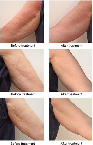 Figure 4 Images at visit 1 (before treatment) on the left and at visit 3 (4 months after the last Radiesse® treatment) on the right show the benefits of treatment on arm appearance.