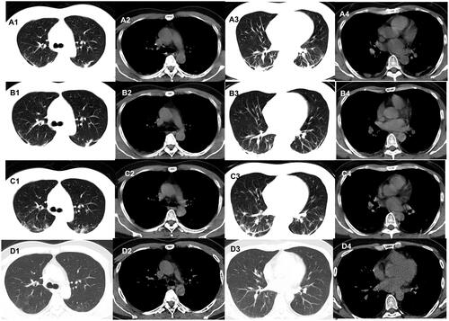 Figure 4. Evolution of the fibrous stripes on chest CT of patients with COVID-19. A 42-year-old man who had close contact with individuals in Wuhan presentedwith fever for 1 day. (A1–A4) The first non-contrast-enhanced chest CT reveals multiple fibrous stripes in the left and right lower lobes (initial chest CT). (B1–B4)Follow-up chest CT 4 days after the first shows that both the scope and density of the lesions decrease (stage I*). (C1–C4) Follow-up chest CT 8 days after the first shows that both the scope and density of the lesions decrease further (stage II*). (D1–D4) Follow-up chest CT 12 days after the first shows that the lesions are almost absorbed completely (stage III*). *The stage does not represent the course of COVID-19 but the time interval between the two adjacent CT scans.