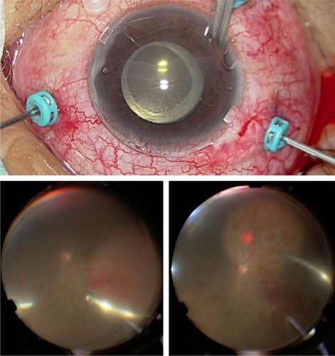 Figure 5 Application of the contact lens on the cornea in a case of diabetic retinopathy with corneal erosion and epithelial edema (top). Fundus view of the wide-angle viewing system alone (bottom left) and during use of the contact lens with the wide-angle viewing system (bottom right).