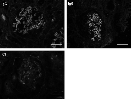 Figure 4. Immunofluorescence with anti-IgG antibody and anti-C3 antibody: capillary linear pattern. IgA, IgM, C4, and C1q were negative.Note: Scale bars = 50 μm.