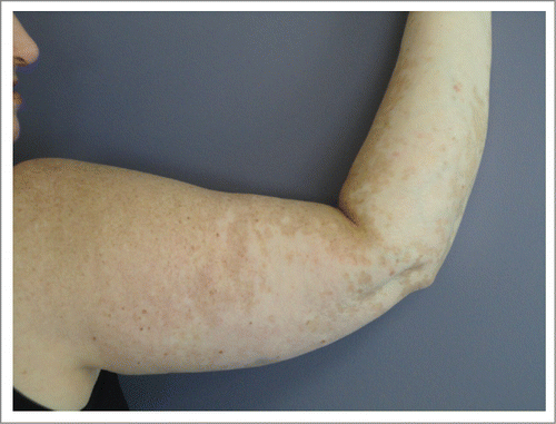Figure 2. Vitiligo of right arm in Patient 1. The photo shows patchy depigmentation of skin after the patient was treated with vemurafenib but this process had actually started after completion of high dose IL-2.