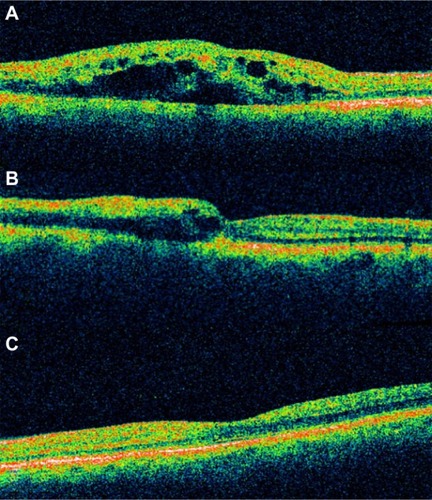 Figure 47 (A) Acute branch retinal vein occlusion with macular edema: the horizontal Stratus optical coherence tomography scan showed numerous hyporeflective spaces within the outer plexiform layer; intraretinal thickening leads to a loss of foveal contour. (B) A decrease of central macular thickness was observed 1 week after intravitreal bevacizumab therapy. (C) A normal macular thickness was seen 2 months after initial therapy.