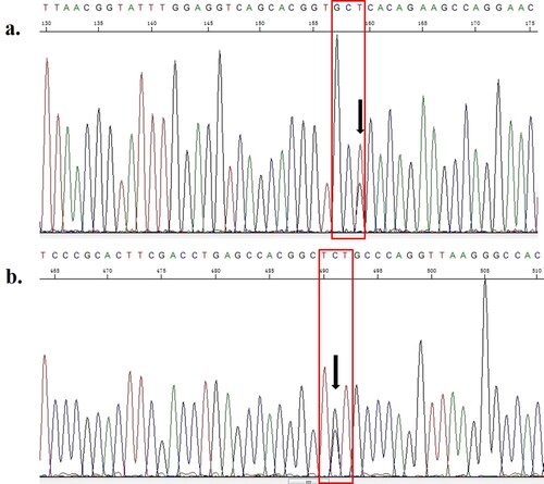 Figure 3. Sequencing result of the α-globin genes. a. Reverse sequencing result of the HBA2 gene in the proband. The arrow indicates the A > C heterozygous mutation substitution at codon 133 [α133(H16) Ser > Arg (AGC > CGC); HBA2: c.400A > C]. b. Forward sequencing result of the HBA1 gene in the proband. The arrow indicates the A > C heterozygous mutation substitution at codon 52 [α52(E6) Ser > Cys (TCT > TGT); HBA1: c.158C > G].