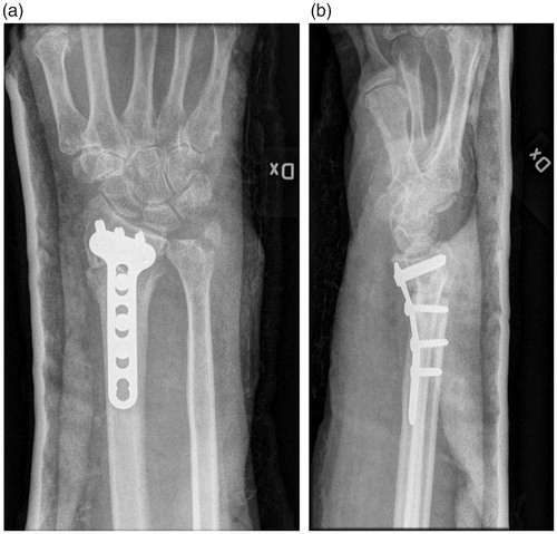 Figure 3. First postoperative control of the same patient as in Figures 1 and 2.The open-wedge corrective osteotomy is fixated with a volar plate. (a) AP view showing axial shortening and ulnar position is now restored. (b) Sagittal view showing volar tilt close to normal.