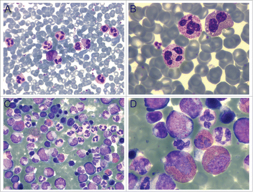 Figure 1. Peripheral blood and bone marrow reveal pathology. (A-B) Peripheral blood smear showing leukocytosis and erythrocytosis. (C-D) Hypercellular bone marrow demonstrating neutrophilia and eosinophilia. A and C: 40X; B and D: 100X. Wright-Giemsa staining in all panels.