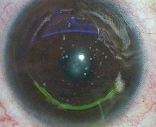 Figure 9 Side-cut tear due to forceful lenticule extraction.