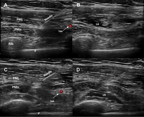 Figure 2 (A) Sonogram of the needle placement for Pecs I block (first injection of Pecs II block). (B) Local anesthetic spread into the fascial plane between the pectoralis major and minor muscles. (C) Sonogram of the needle placement for second injection of Pecs II block. (D) Local anesthetic spread into the fascial plane between pectoralis minor and serratus anterior muscles.Abbreviations: PMj, pectoralis major muscle; PMn, pectoralis minor muscle; TAA, pectoral branch of the thoracoacromial artery; P, pleura; LA, local anesthetic.