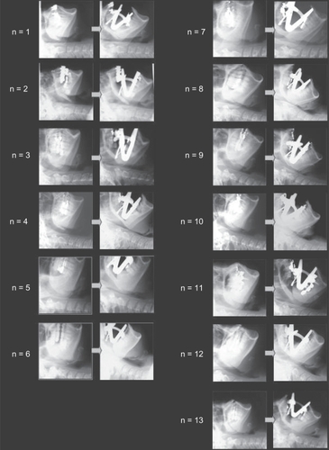 Figure 2 Individual cephalograms for each patient. All subjects indicated upper airway constriction by maximum opening of the mouth.