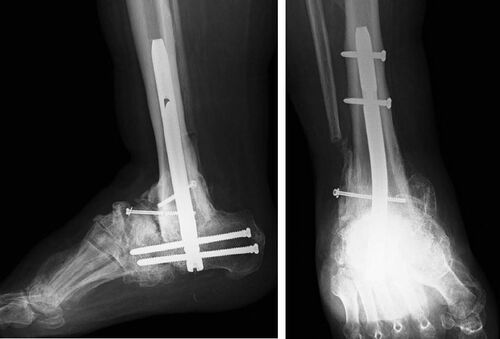 Figure 3. Solid tibiocalcaneal fusion using the Trigen Hindfoot Fusion Nail.
