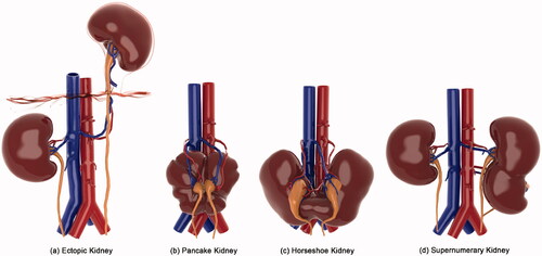 Figure 9. Alphy Pullely – The above visuals depict 2D images of 3D models of four congenital kidney anomalies (a) Ectopic Kidney, (b) Pancake Kidney, (c) Horseshoe Kidney, (d) Supernumerary Kidney. These variations were modelled using Zbrush 3D software and high quality 2D images were rendered using Keyshot 8 software.