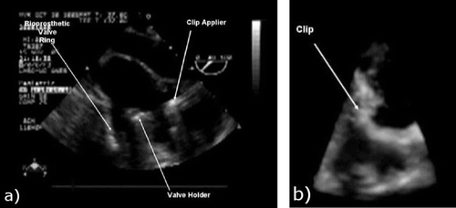 Figure 2. a) Two-dimensional TEE image of the valve tool and clip applier inside a beating porcine heart. b) Three-dimensional US image of a similar scene. Note the difficulty in interpreting the anatomical features and surgical tools and the limited field of view with 3D US.