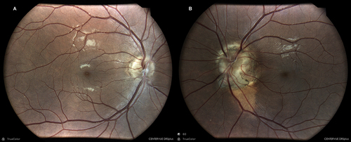 Figure 1. Drsplus colour fundus images. A: unexceptional right optic disc. B: the left optic disc lies slightly decentred at the base of a peripapillary staphyloma. Pigmentary changes involving the walls and inferotemporal margin of the ectasia are evident.