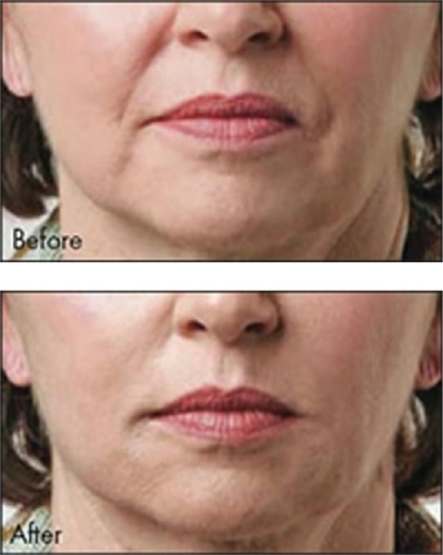 Figure 2 A clinical example of the use of Captique™ for nasolabial folds.