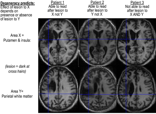 Figure 4. An example of degeneracy. Reading is impaired following lesions that damage the left putamen, left insula, and left parietal cortex inclusively (Patient 3). However, damage to only one of these regions does not impair reading (Patients 1 and 2). The results suggest that reading can be supported either by a pathway that involves the parietal cortex or by a pathway that involves the putamen/insula. When one pathway is damaged, the other pathway can support reading. When both pathways are damaged, reading is impaired. This previously unpublished result is consistent with a study of reading aloud in healthy subjects (Seghier, Lee, Schofield, Ellis, & Price, Citation2008) that showed an inverse relationship (across participants) between activation in the left putamen and parietal cortex. Together, the results from patient studies (above) and healthy subjects (Seghier et al., Citation2008) suggest that the putamen and parietal cortex are components of different reading pathways and that either one or the other is needed for successful reading.